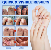 Fungus Nail Patches