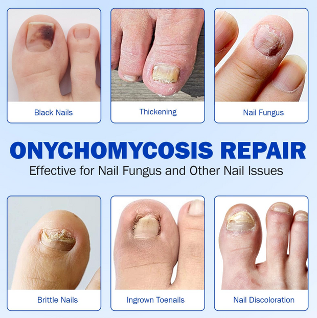 Fungus Nail Patches